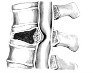 Compression of the spinal cord