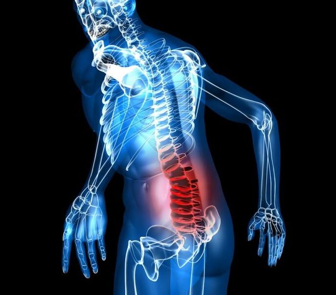 Diploma and stages of development of lumbar osteochondrosis