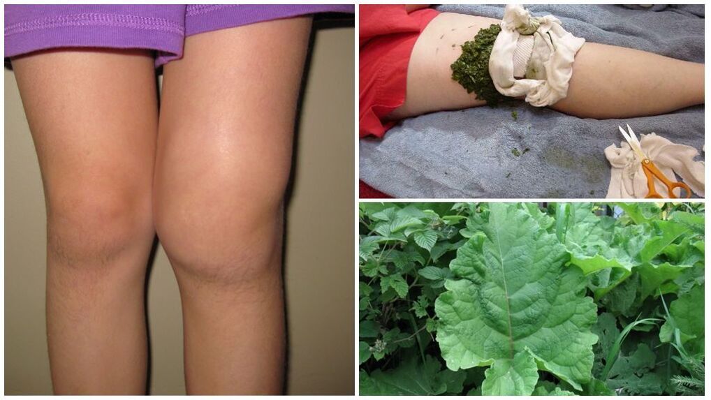 Compress on the knee with burdock - a popular method of treating gonarthrosis