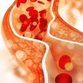 Cholesterol deposition on the inner walls of blood vessels causes pain on the side of the neck.