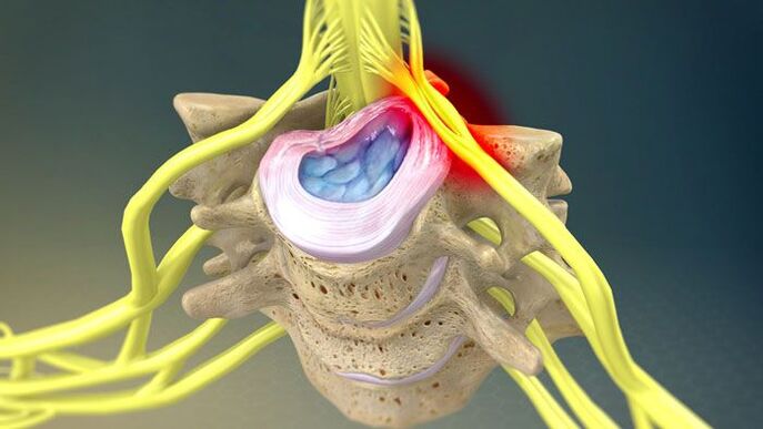 Protruding intervertebral disc causes neck pain